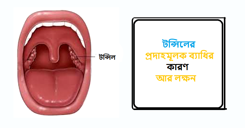 Tonsillitis Meaning In Bengali